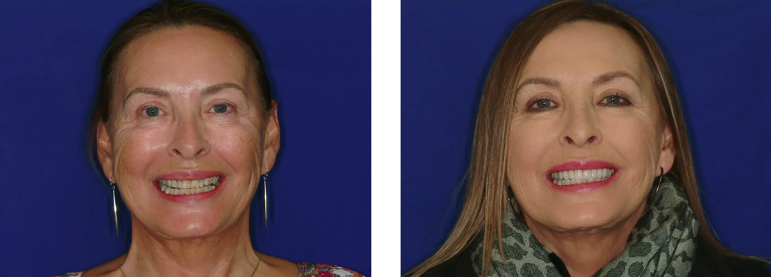 smile gallery, before and afters, smile makeover,