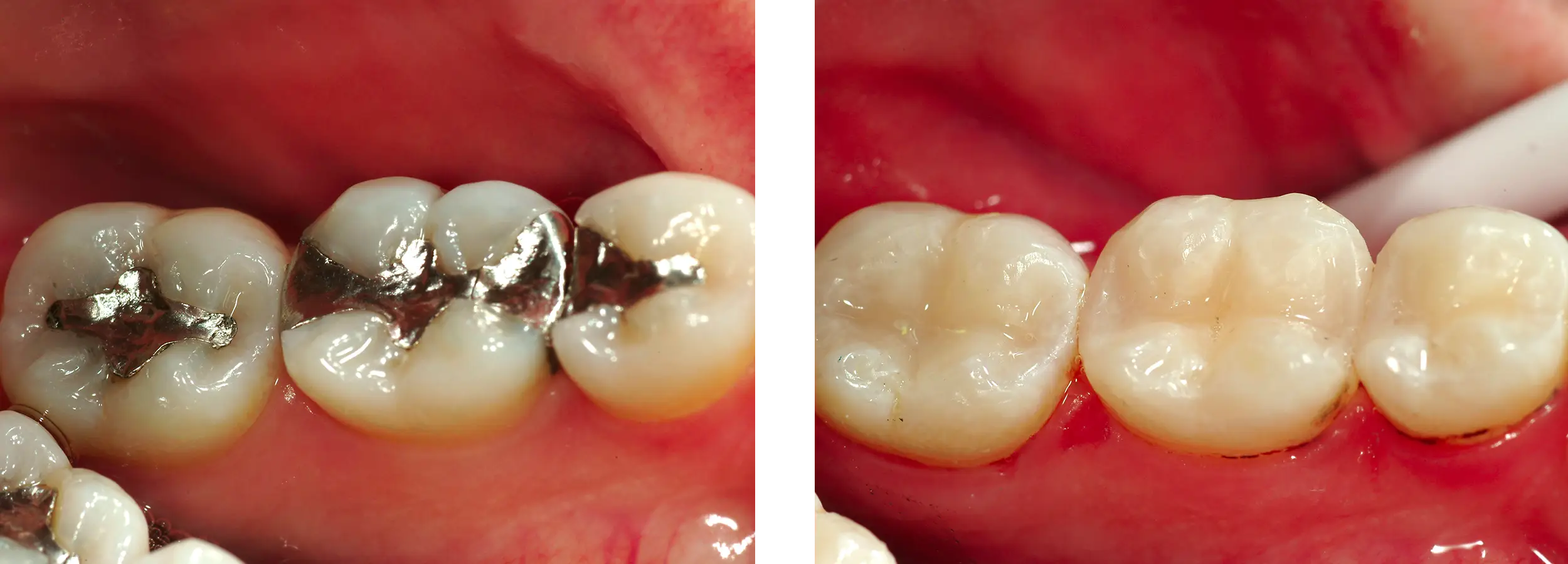 smile gallery, before and afters, Restorative Dentistry