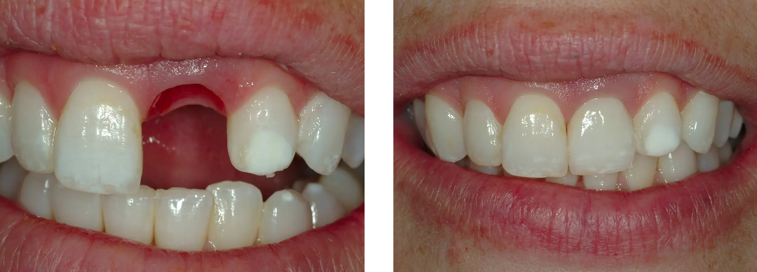 implant, smile gallery, before and afters,
