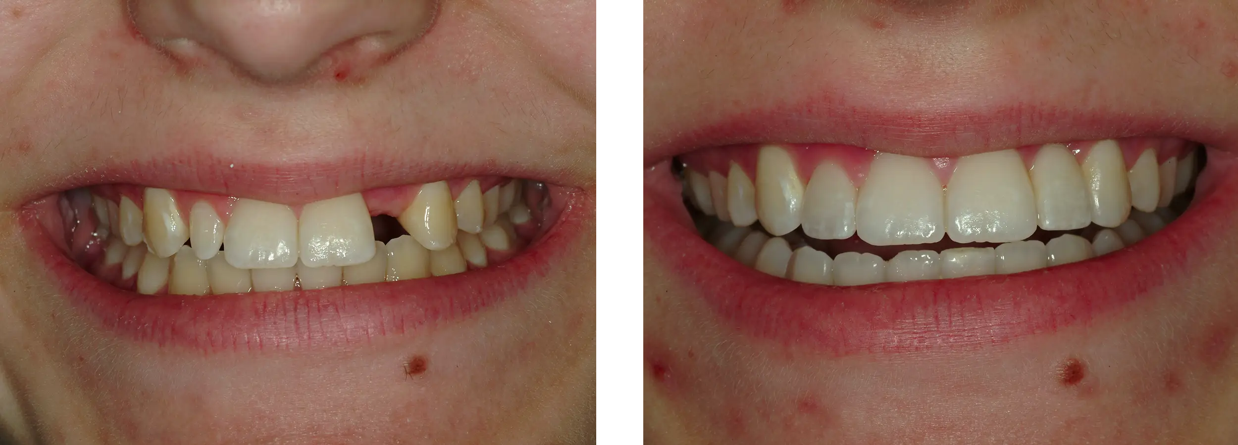 bridge, smile gallery, before and afters,