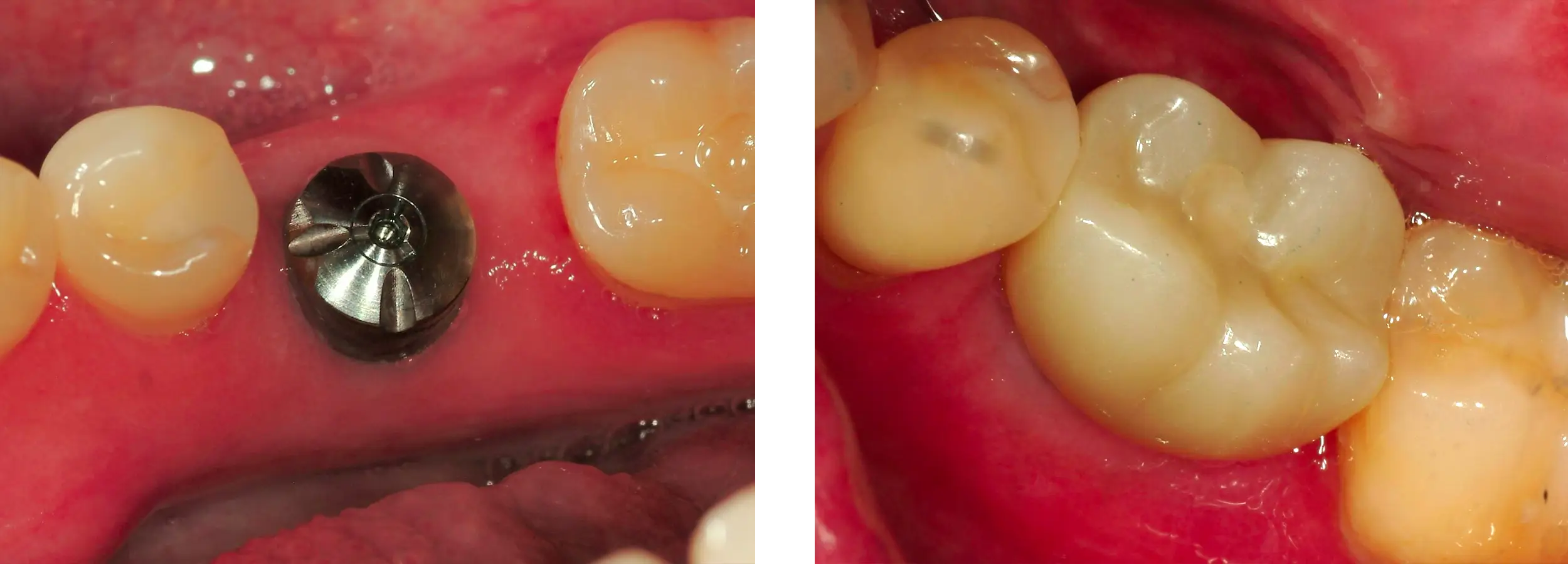 implant, smile gallery, before and afters,